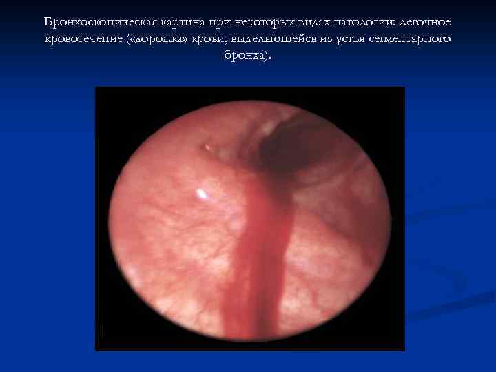 Бронхоскопическая картина при некоторых видах патологии: легочное кровотечение ( «дорожка» крови, выделяющейся из устья
