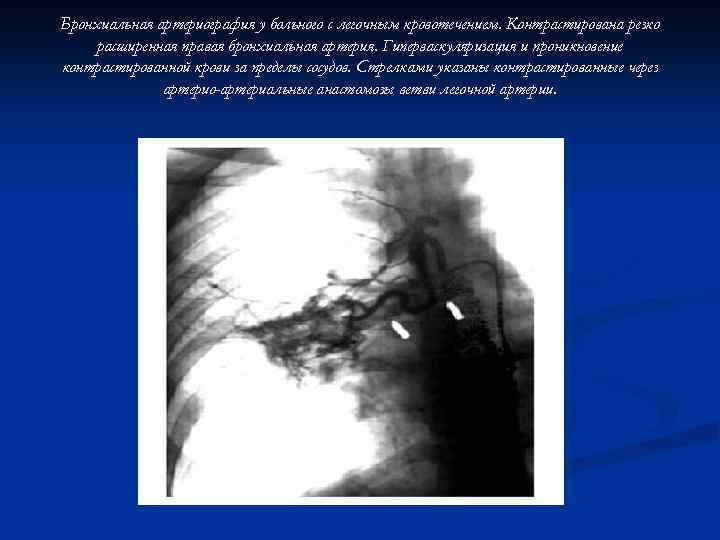 Бронхиальная артериография у больного с легочным кровотечением. Контрастирована резко расширенная правая бронхиальная артерия. Гиперваскуляризация