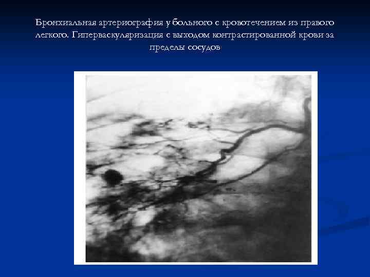 Бронхиальная артериография у больного с кровотечением из правого легкого. Гиперваскуляризация с выходом контрастированной крови