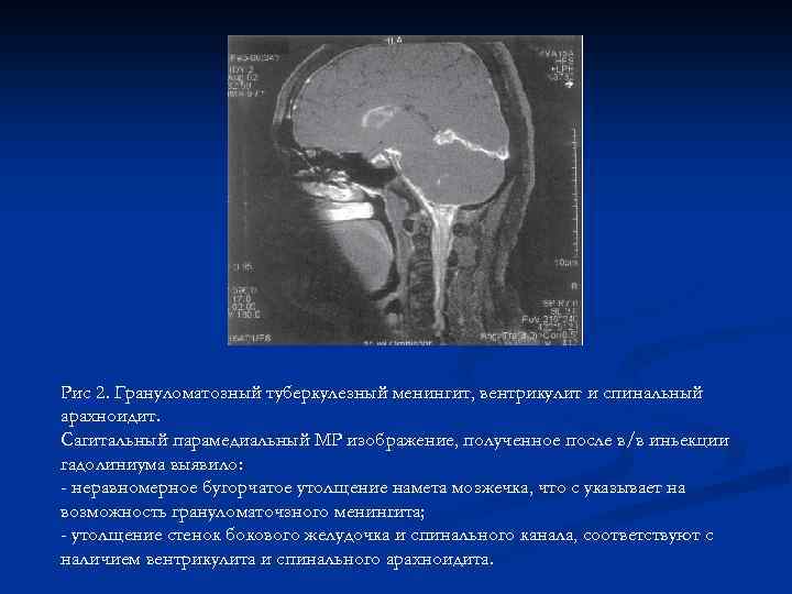 Рис 2. Грануломатозный туберкулезный менингит, вентрикулит и спинальный арахноидит. Сагитальный парамедиальный МР изображение, полученное