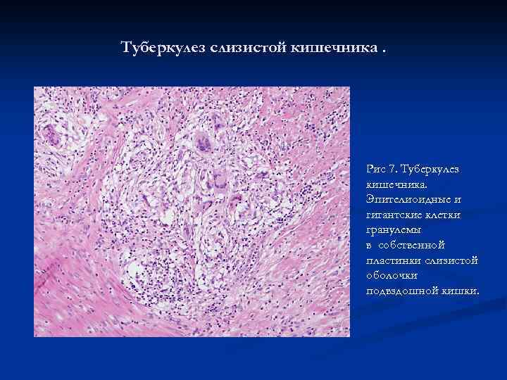 Туберкулез слизистой кишечника. Рис 7. Туберкулез кишечника. Эпителиоидные и гигантские клетки гранулемы в собственной