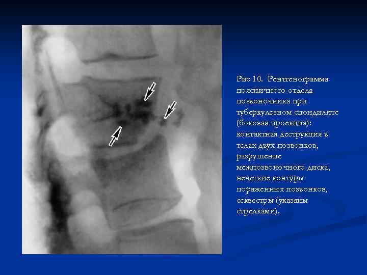 Рис 10. Рентгенограмма поясничного отдела позвоночника при туберкулезном спондилите (боковая проекция): контактная деструкция в