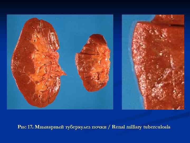 Рис 17. Милиарный туберкулез почки / Renal miliary tuberculosis 