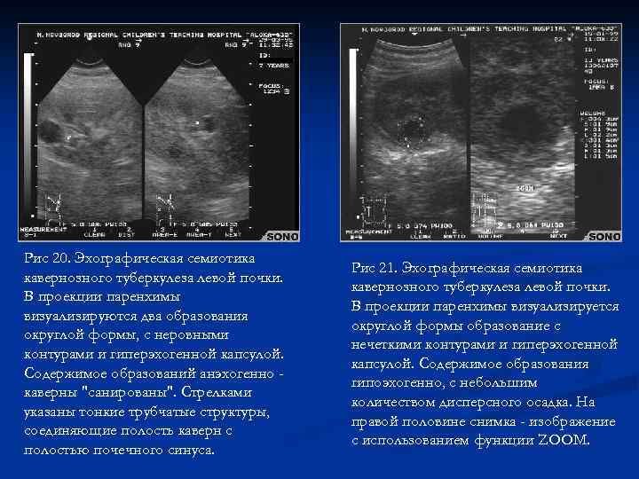 Рис 20. Эхографическая семиотика кавернозного туберкулеза левой почки. В проекции паренхимы визуализируются два образования