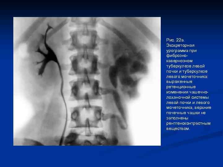 Рис. 22 а. Экскреторная урограмма при фибрознокавернозном туберкулезе левой почки и туберкулезе левого мочеточника: