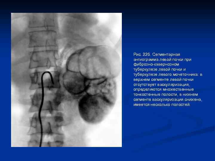 Рис. 22 б. Сегментарная ангиограмма левой почки при фиброзно-кавернозном туберкулезе левой почки и туберкулезе