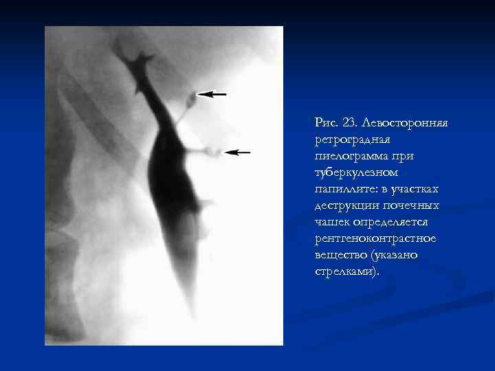 Рис. 23. Левосторонняя ретроградная пиелограмма при туберкулезном папиллите: в участках деструкции почечных чашек определяется