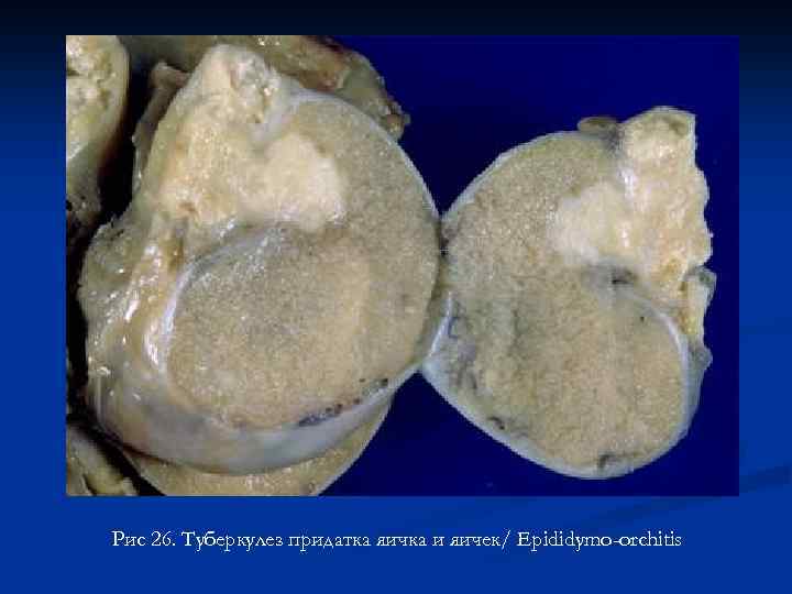 Рис 26. Туберкулез придатка яичка и яичек/ Epididymo-orchitis 