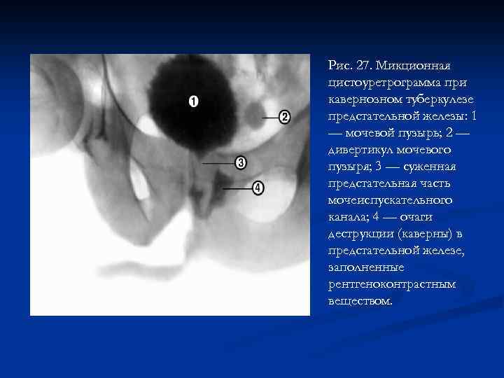 Рис. 27. Микционная цистоуретрограмма при кавернозном туберкулезе предстательной железы: 1 — мочевой пузырь; 2