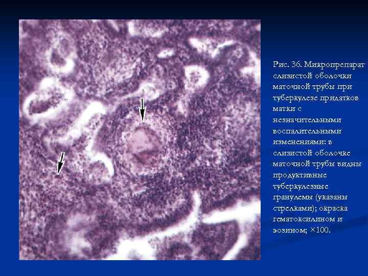 Рис. 36. Микропрепарат слизистой оболочки маточной трубы при туберкулезе придатков матки с незначительными воспалительными