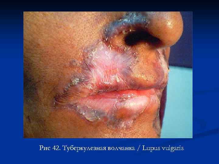 Рис 42. Туберкулезная волчанка / Lupus vulgaris 