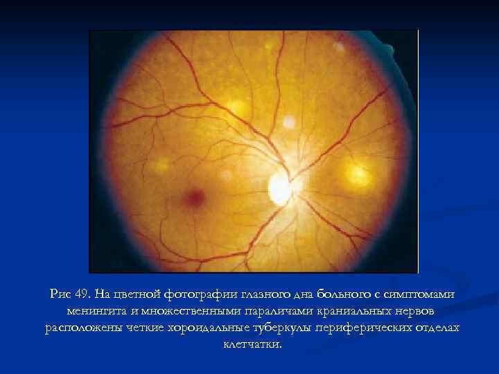 Рис 49. На цветной фотографии глазного дна больного с симптомами менингита и множественными параличами