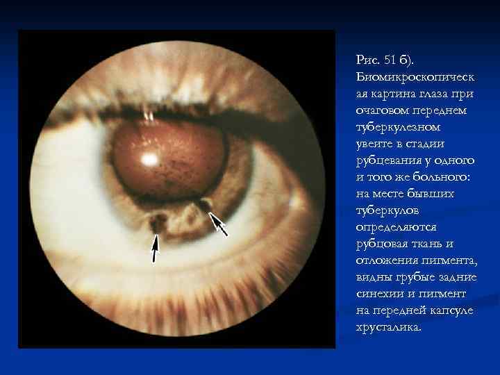 Рис. 51 б). Биомикроскопическ ая картина глаза при очаговом переднем туберкулезном увеите в стадии