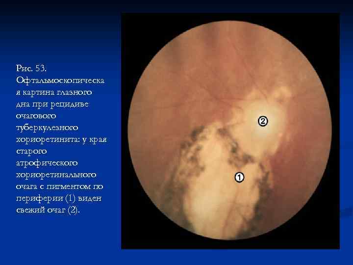 Рис. 53. Офтальмоскопическа я картина глазного дна при рецидиве очагового туберкулезного хориоретинита: у края