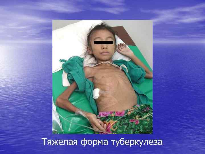 Тяжелая форма туберкулеза 