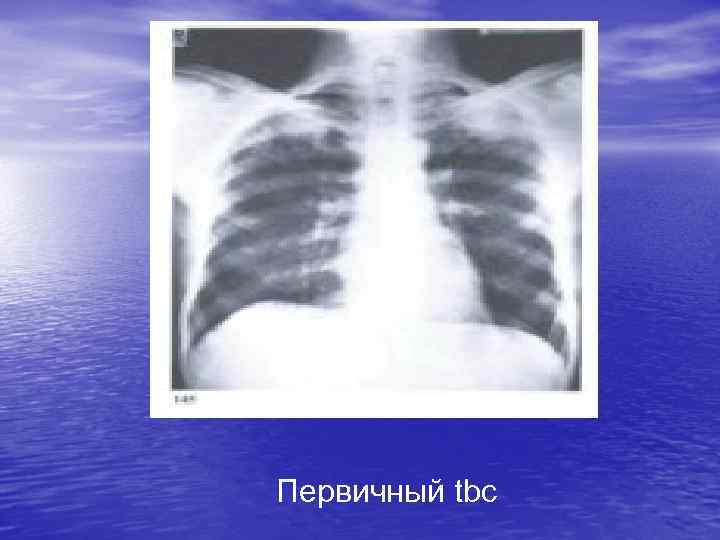 Первичный tbc 