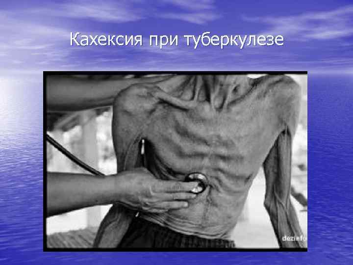 Кахексия при туберкулезе 