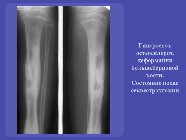 Остеосклероз лечение. Остеосклероз и остеомиелит. Кортикальный гиперостоз. Периостоз большеберцовой кости. Локальный остеомиелит большеберцовой кости рентген.