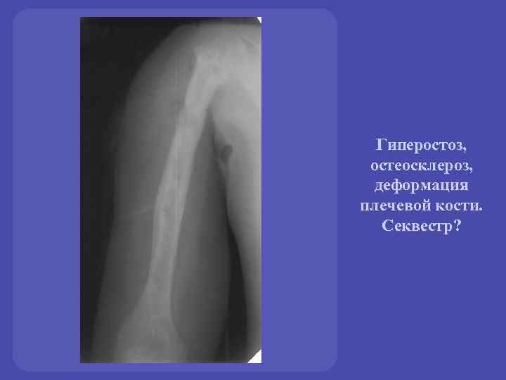 Гиперостоз, остеосклероз, деформация плечевой кости. Секвестр? 