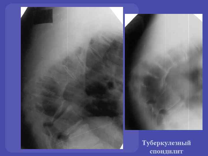 Туберкулезный спондилит 