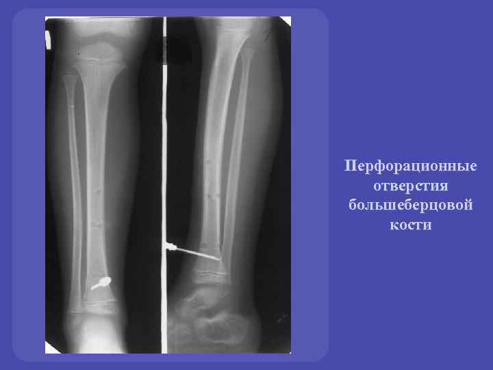 Перфорационные отверстия большеберцовой кости 