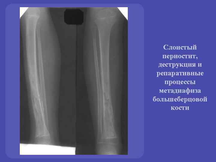 Воспаление надкостницы. Периостит бедренной кости рентген. Рентген воспаления надкостницы голени. Линейный периостит большеберцовой кости. Периостит большеберцовой кости на рентгене.