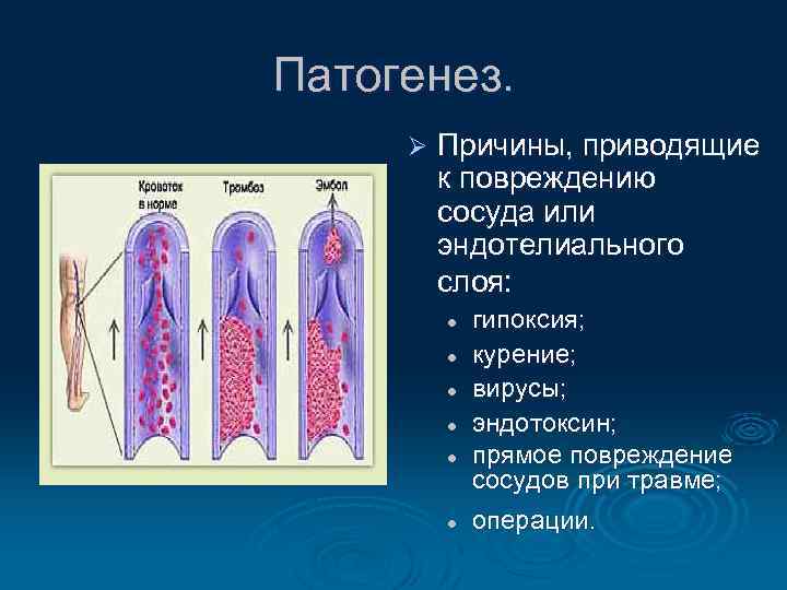 Патогенез. Ø Причины, приводящие к повреждению сосуда или эндотелиального слоя: l l l гипоксия;