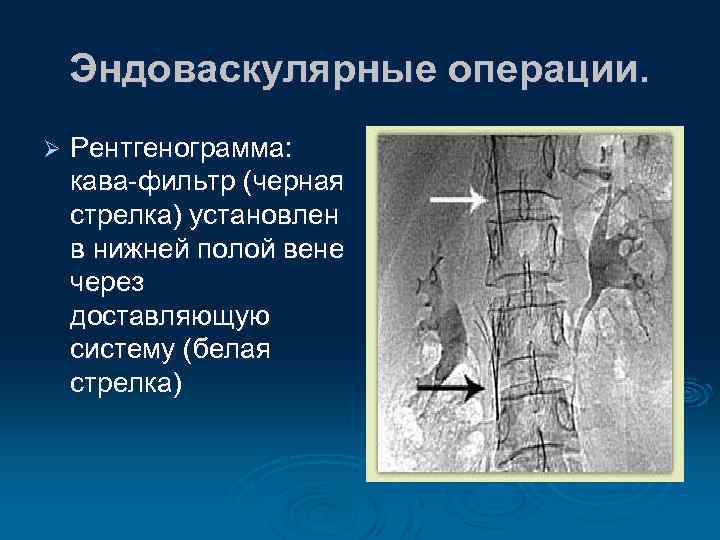 Острые тромбозы системы нижней полой вены презентация