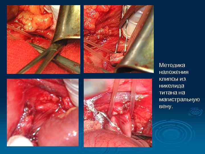 Методика наложения клипсы из никелида титана на магистральную вену. 