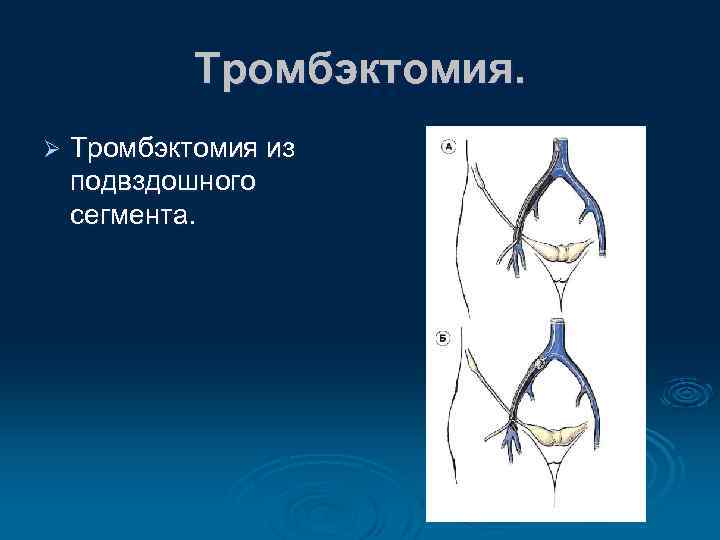 Тромбэктомия. Ø Тромбэктомия из подвздошного сегмента. 