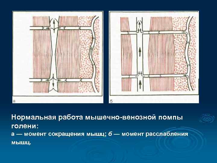 Нормальная работа мышечно-венозной помпы голени: а — момент сокращения мышц; б — момент расслабления