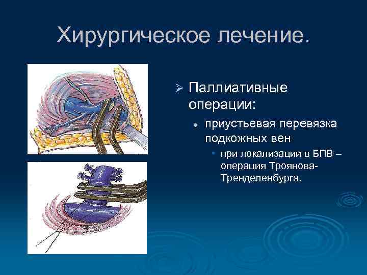 Хирургическое лечение. Ø Паллиативные операции: l приустьевая перевязка подкожных вен • при локализации в