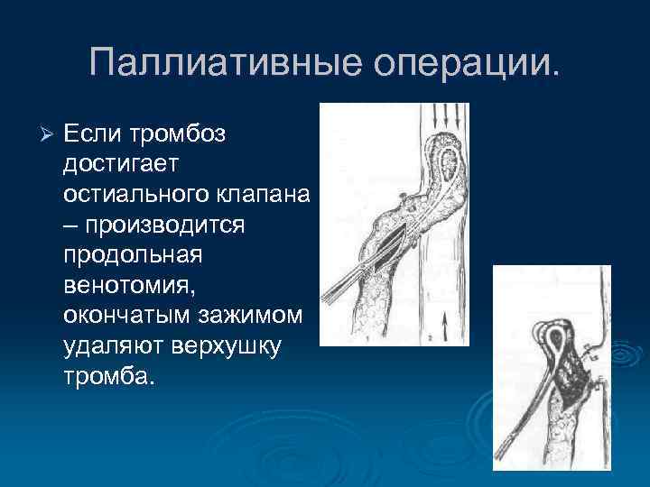 Паллиативные операции. Ø Если тромбоз достигает остиального клапана – производится продольная венотомия, окончатым зажимом