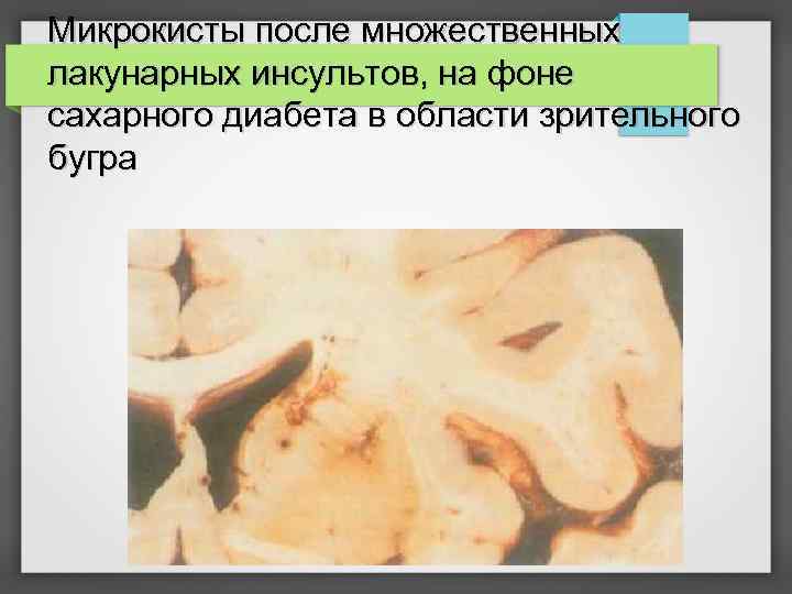 Микрокисты после множественных лакунарных инсультов, на фоне сахарного диабета в области зрительного бугра 
