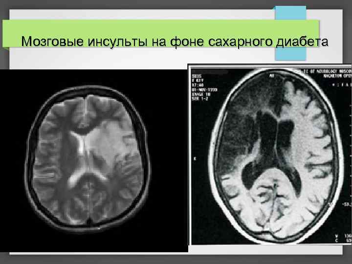 Мозговые инсульты на фоне сахарного диабета 