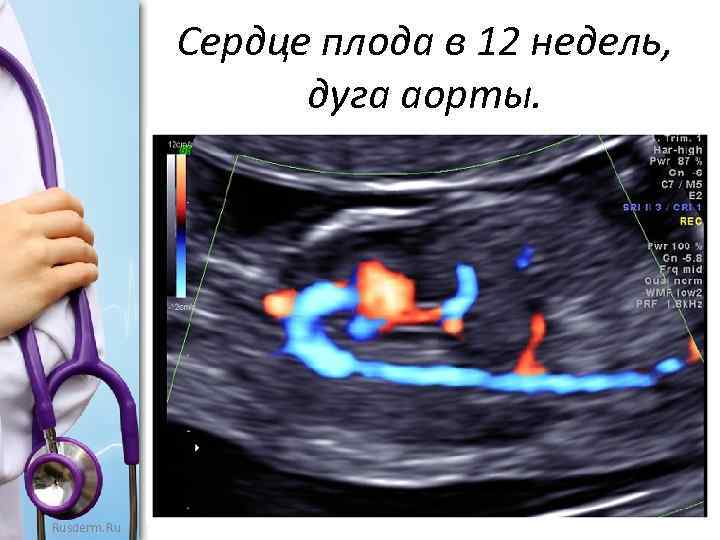 Сердце плода в 12 недель, дуга аорты. Rusderm. Ru 