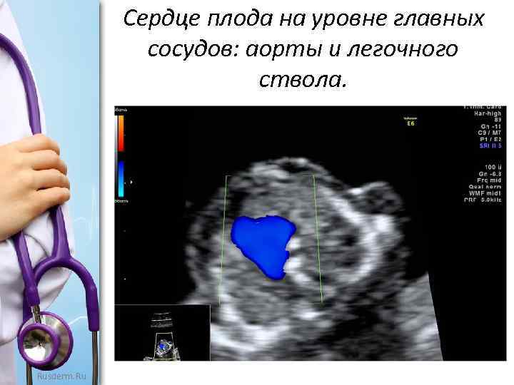 Сердце плода на уровне главных сосудов: аорты и легочного ствола. Rusderm. Ru 
