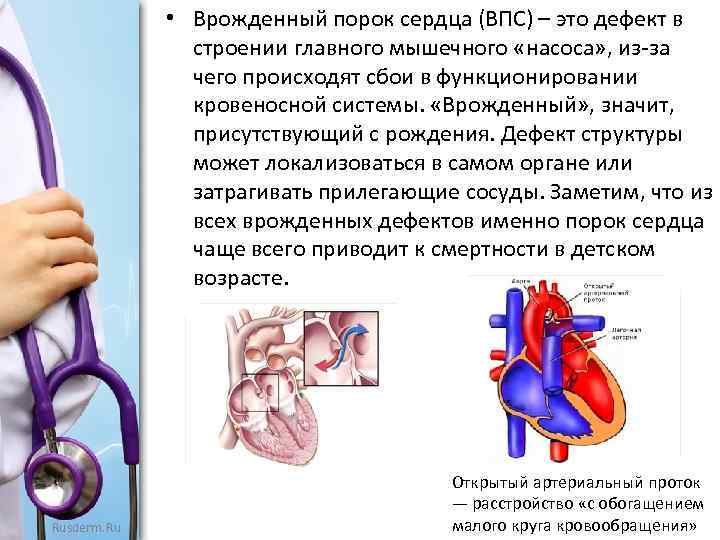  • Врожденный порок сердца (ВПС) – это дефект в строении главного мышечного «насоса»