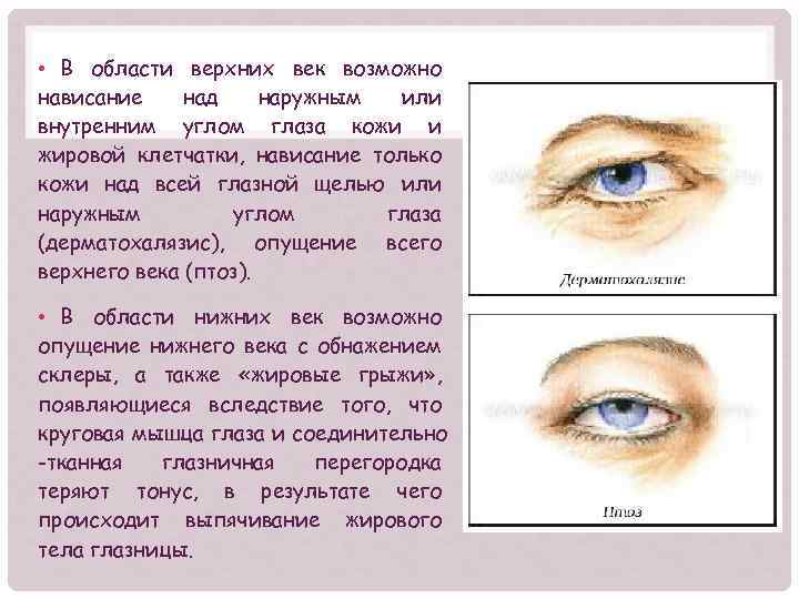  • В области верхних век возможно нависание над наружным или внутренним углом глаза