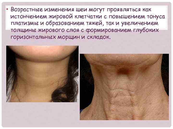  • Возрастные изменения шеи могут проявляться как истончением жировой клетчатки с повышением тонуса