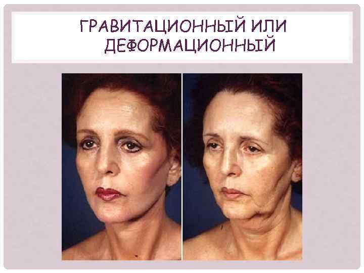 ГРАВИТАЦИОННЫЙ ИЛИ ДЕФОРМАЦИОННЫЙ 