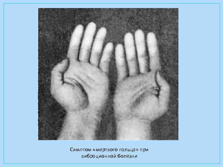 Симптом «мертвого пальца» при вибрационной болезни 