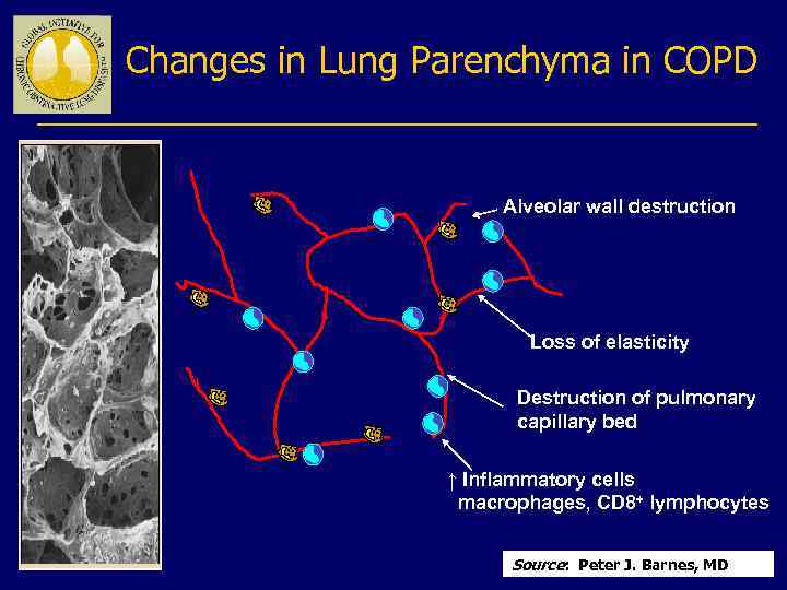 Changes in Lung Parenchyma in COPD Alveolar wall destruction Loss of elasticity Destruction of