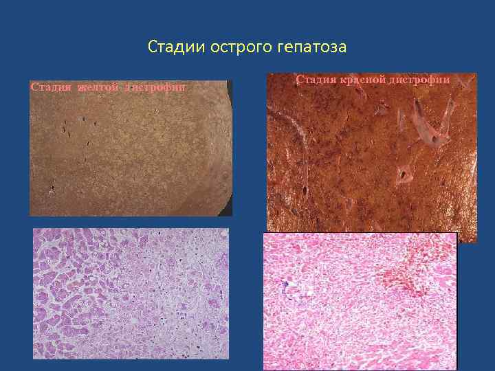 Стадии острого гепатоза Стадия желтой дистрофии гепатоз Стадия красной дистрофии 