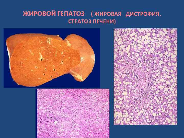 ЖИРОВОЙ ГЕПАТОЗ ( ЖИРОВАЯ ДИСТРОФИЯ, СТЕАТОЗ ПЕЧЕНИ) 