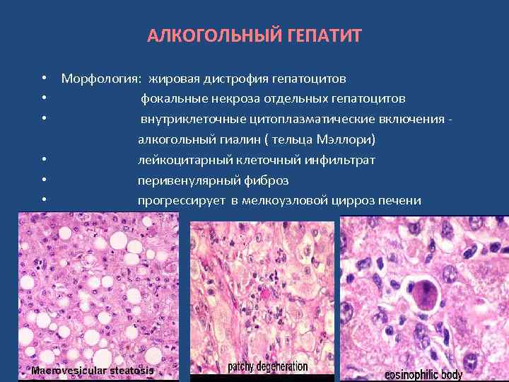 АЛКОГОЛЬНЫЙ ГЕПАТИТ • Морфология: жировая дистрофия гепатоцитов • фокальные некроза отдельных гепатоцитов • внутриклеточные