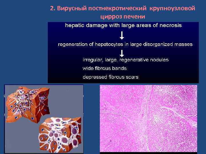2. Вирусный постнекротический крупноузловой цирроз печени 
