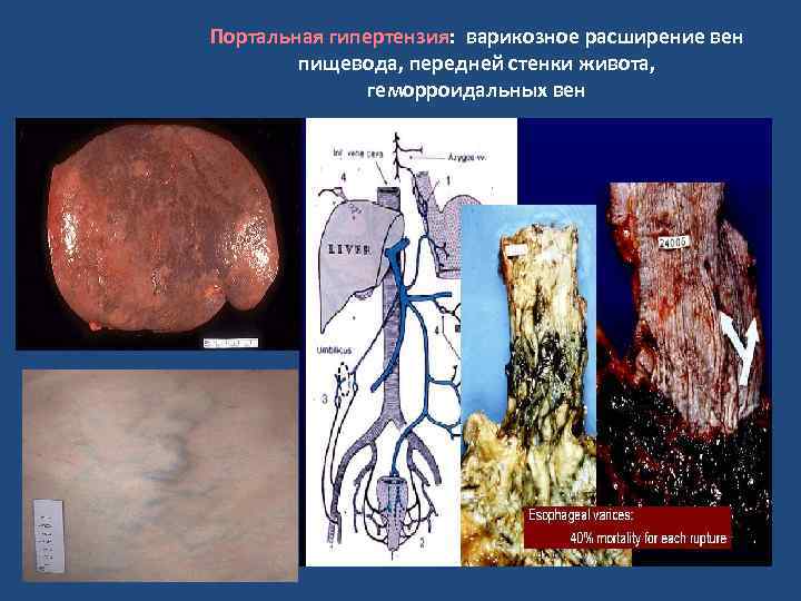 Портальная гипертензия: варикозное расширение вен пищевода, передней стенки живота, геморроидальных вен 