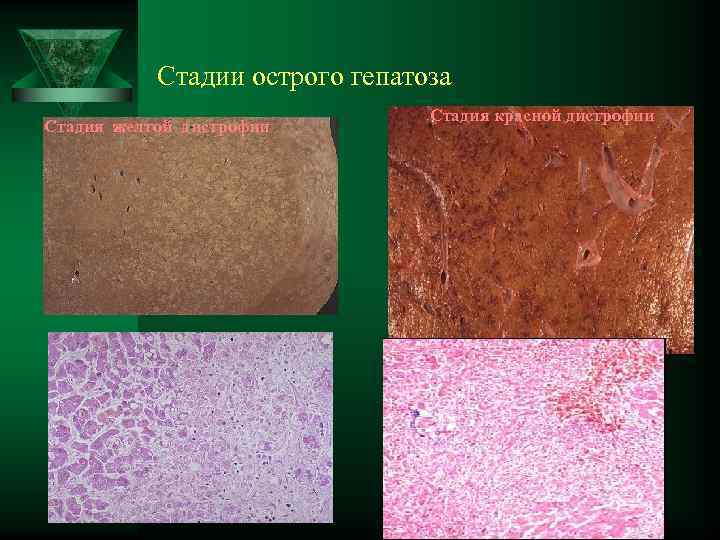 Стадии острого гепатоза Стадия желтой дистрофии гепатоз Стадия красной дистрофии 