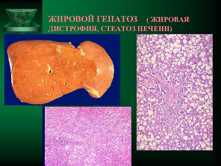ЖИРОВОЙ ГЕПАТОЗ ( ЖИРОВАЯ ДИСТРОФИЯ, СТЕАТОЗ ПЕЧЕНИ) 